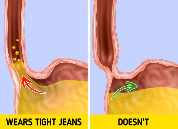Tăng nguy cơ ợ nóng. Chú ý quan sát, bạn sẽ nhận thấy mặc quần jeans thời gian dài sẽ để lại đường hằn sâu, tấy đỏ quanh eo. Chuyên gia cho biết, quần áo bó sát tạo áp lực quanh vùng bụng có thể gây trào ngược axit.