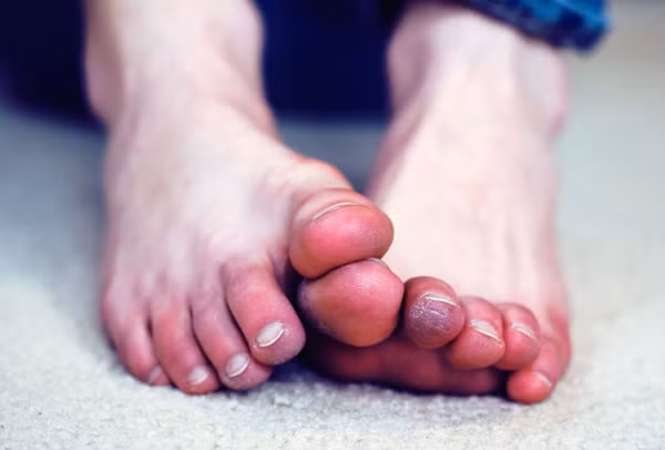Chân tay lạnh, tê mỏi. Người có vấn đề về tim, cơ thể sẽ xuất hiện triệu chứng chân lạnh, mệt mỏi triền miên. Ngoài yếu tố môi trường, tim hoạt động không tốt cũng khiến tình trạng thêm trầm trọng. Lúc này, việc cung cấp oxy và máu sẽ bị ảnh hưởng, máu lưu thông chậm khiến bàn chân lạnh.
