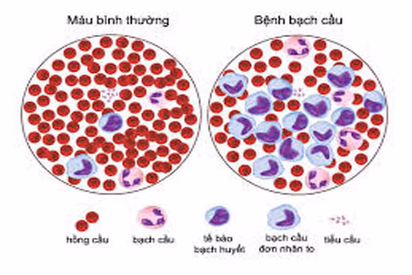 Bệnh bạch cầu. Tuy rằng, mối liên quan giữa hai bệnh này hiếm gặp nhưng chúng ta cũng không nên chủ quan. Có thể là do biến chứng liên quan với liệu pháp ức chế miễn dịch như cytoxan (cyclophosphamide) và azasan (azathioprine), được sử dụng để điều trị RA nặng gây bệnh ung thư . Thuốc methotrexate cũng liên quan với sự gia tăng tỷ lệ mắc bệnh bạch cầu.