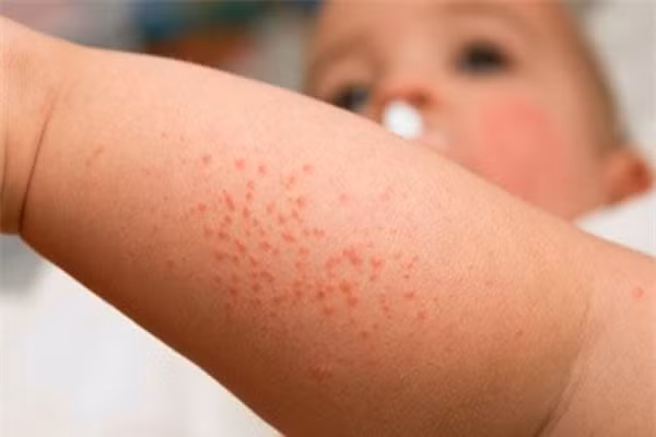 Nhiệt phát ban (gai nhiệt mùa hè hay phát ban). Trẻ sẽ bị nổi mụn đỏ nhỏ xíu trên những vùng của cơ thể do nóng và mồ hôi. Các mụn đỏ sẽ nổi ở các vùng quần áo cọ xát mạnh vào người bé như cổ, ngực, bụng hoặc háng trong mùa hè. Đây là căn bệnh nhẹ, nhưng nó là dấu hiệu chứng tỏ em bé quá nóng. Vì vậy hãy làm cho không gian của bé mát và thoáng đãng hơn thì những nốt ban sẽ lặn.