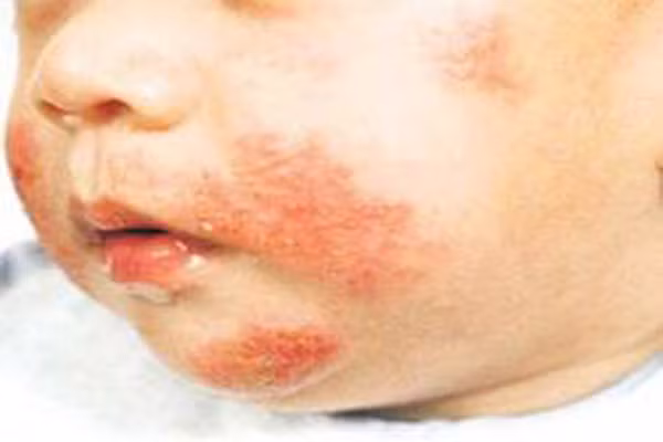Chàm Eczema. Là tình trạng da bị viêm mãn tính làm cho da bị đỏ, khô, bong vẩy và ngứa. Hiện nay, vẫn chưa tìm ra nguyên nhân chính xác gây ra bệnh này và nó thường phổ biến ở những đối tượng có tiền sử gia đình bị bệnh rối loạn dị ứng như hen suyển hay sốt mùa hè. Tình trạng bệnh này thường xuất hiện trong năm đầu tiên bé ra đời. Bệnh Eczema thường kéo dài hoặc mãn tính nhưng trong nhiều trường hợp, bệnh sẽ khỏi trước khi bé trưởng thành.