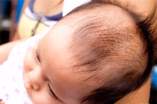  Viêm nấm da, bã nhờn. Nó sẽ có màu vàng hoặc nâu trên đầu bé. Lớp da vùng này sẽ rất dễ bong và da thường bị ửng đỏ. Nguyên nhân có thể do tình trạng các tuyến bã nhờn bị kích thích bởi hormone của mẹ trong tử. Ngoài ra, yếu tố gen và môi trường cũng có thể tác động đến nguyên nhân khởi phát và diễn tiến của bệnh. Bệnh này thường vô hại và sẽ hết sau 3 tháng .