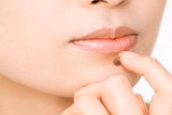 4. Thay đổi màu sắc đột ngột. Nốt ruồi xuất hiện trên da bạn vẫn không đáng lo ngại bằng nốt rồi từ nâu chuyển sang đen nhanh chóng. Bạn phải cẩn thận đi gặp ngay bác sỹ da liễu.