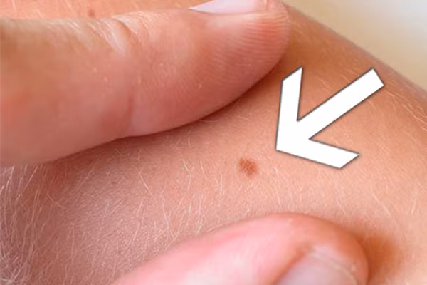 5. Đường kính. Nếu nó có đường kính lớn hơn 6 mm có nguy cơ là dấu hiệu bệnh ung thư. Nói chung, nốt hoặc đốm thường lành mạnh. Vì vậy, bạn nên đi đến gặp bác sỹ nếu bạn có nốt ruồi và đốm lão hóa có đường kính ngày càng phát triển.