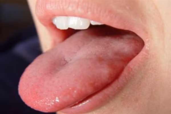 Canh bao dau hieu ung thu luoi bat ngo ban nen biet