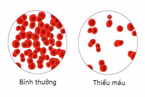Tuy nhiên, AB đừng vì thế mà lo lắng vì tình trạng này không quá phổ biến. Nhóm máu AB cũng có xu hướng dễ bị đông máu và có thể dẫn đến các cơn đau tim, đột quỵ hoặc tắc nghẽn tĩnh mạch do mức độ protein cao hơn.