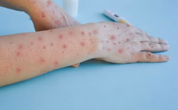 Lo ngại nguy cơ đồng nhiễm HIV và đậu mùa khỉ Lo ngai nguy co dong nhiem HIV va dau mua khi
