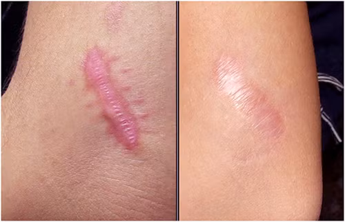 Cách dùng: Ngâm 1 nắm rau má với nước muối pha khoảng 10 phút rửa thật sạch lại bằng nước. Cho toàn bộ rau má vào trong máy sinh tố, đổ thêm 80-100ml nước, xay nhuyễn. Rửa mặt sạch với nước, lau khô bằng khăn mềm sau đó thoa nước rau má xung quanh vết bỏng. Massage nhẹ nhàng để dưỡng chất dễ dàng thẩm thấu vào sâu bên trong. Đắp thư giãn trong 15-20 phút sau đó rửa lại bằng nước sạch.