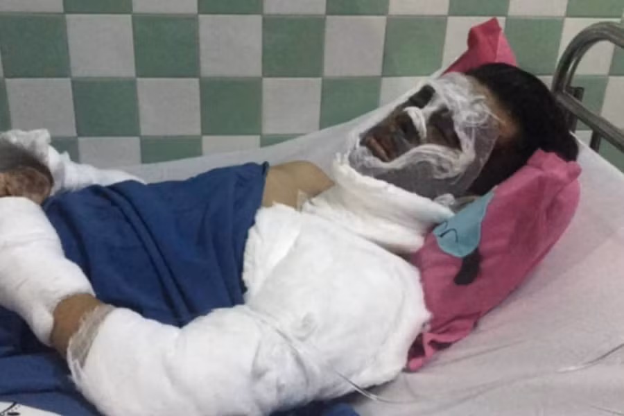 Tinh tiet soc vu doi nam nu Viet Kieu bi tat axit, cat gan chan