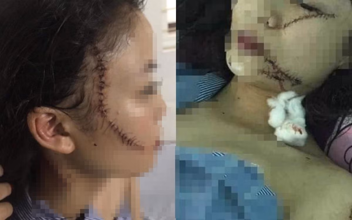 Tam su dam nuoc mat cua chi co gai bi tan cong phai khau 60 mui