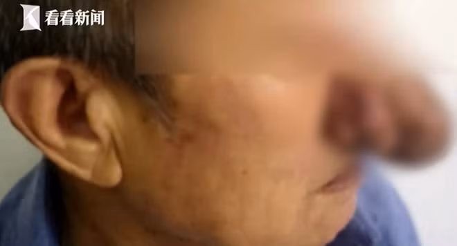 Mui dai ra nhu phu thuy vi nghien ruou suot 10 nam