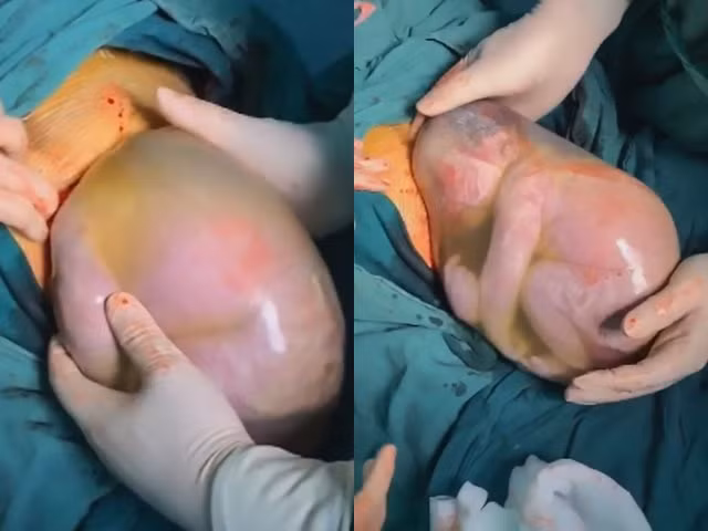 Hy hữu: Bé trai sinh non còn nguyên trong túi ối, nhăn nhó không muốn ra ngoài - Hình 2 Hy huu: Be trai sinh non con nguyen trong tui oi, nhan nho khong muon ra ngoai-Hinh-2
