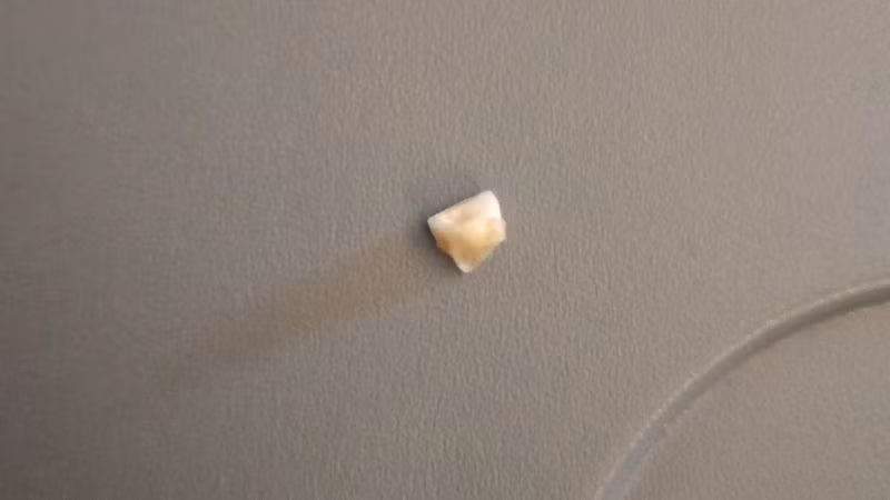 Bradley Button nói anh đã phát hiện một cái răng trong bữa ăn của Singapore Airlines.