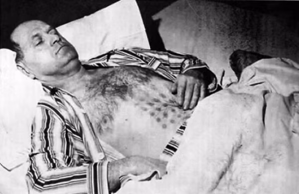 Năm 1967, Stefan Michalak bắt gặp một vật thể bay không xác định gần hồ Falcon, Canada. Khi Michalak gần chạm vào nó thì vật thể đó bất ngờ bay lên và đập vào lưng anh. Ống xả của vật thể đó khiến Michalak bị bỏng và sau tai nạn đó, anh bị nhiễm phóng xạ và trở nên ốm yếu.