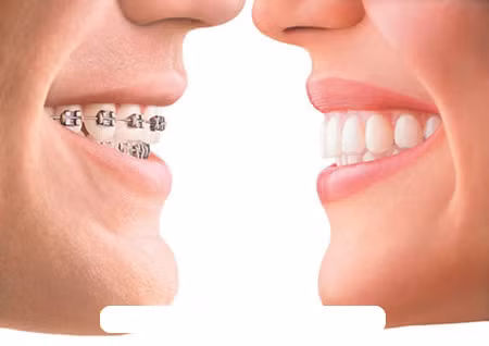 Mặc dù có nhiều lợi ích nhưng niềng răng cũng gây ra một số tác hại không mong muốn. Trong một số trường hợp không cần thiết, việc niềng răng có thể làm cho răng yếu đi. Thậm chí, nếu các bác sĩ thao tác không cẩn thận, có thể còn gây hại cho răng.