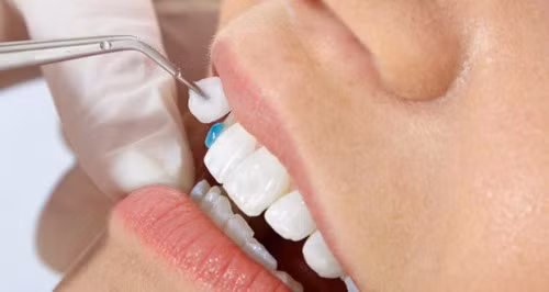 Ngoài ra bạn còn có thể phải chịu những di chứng cực nặng nề khi mài răng để bọc răng sứ. Sau khi mài răng bọc răng sứ, bạn sẽ phải chịu những cơn đau đớn khá khủng khiếp.