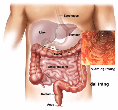 Bước 4: Sinh thiết sét nghiệm xem u đại tràng bạn mắc nếu có lành tính hay ác tính.