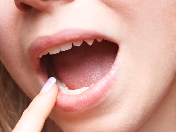 Phục hồi các vết loét miệng. Hỗn hợp nước ép trái cây tự nhiên này có chứa các chất kháng viêm, giúp chữa lành các vết loét và về thương nhỏ. 