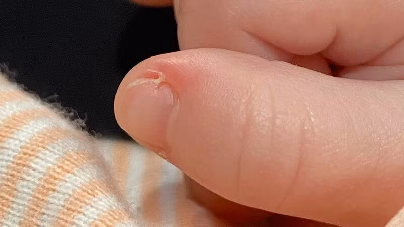 Cắt xước măng rô, bé trai suy tim phổi suýt chết Cat xuoc mang ro, be trai suy tim phoi suyt chet