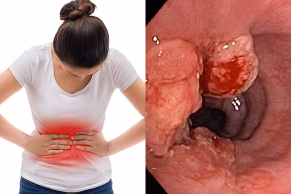 Các dấu hiệu của ung thư dạ dày rất dễ nhầm với các bệnh đường tiêu hoá