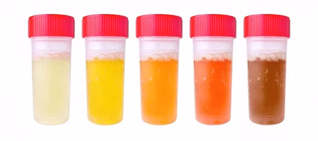 10 dấu hiệu chứng tỏ bạn mắc bệnh thận mà không hề hay biết - Hình 4 10 dau hieu chung to ban mac benh than ma khong he hay biet-Hinh-4