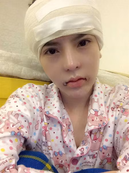 "Mình phẫu thuật nâng mũi, gọt cằm, chỉnh xương hàm cho hết hô, hút mỡ toàn thân, đặt túi ngực. Nói chung mình đã thực hiện gần như đầy đủ các loại hình phẫu thuật thẩm mỹ có hiện nay", cô nói.