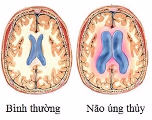 Bình thường, DNT luôn hiện diện trong não, có tác dụng giảm các sang chấn tác động từ bên ngoài vào. DNT được bộ phận rối mạch mạc tiết ra và được bộ phận khác có tên Pacchioni lấy đi.