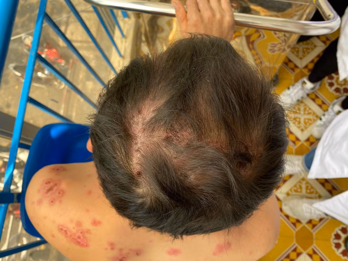 Lở loét toàn thân, rụng tóc vì bệnh Rowell hiếm gặp - Hình 4 Lo loet toan than, rung toc vi benh Rowell hiem gap-Hinh-4