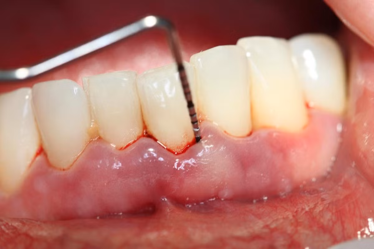 Sưng nướu, chảy máu chân răng. Nicotin của khói thuốc khiến răng ngả màu vàng, gây chảy máu nướu răng, làm người bệnh nhai khó, hoặc gặp các vấn đề về hôi miệng. Nếu nghiện thuốc, dẫn tới mất canxi ở xương và răng, từ đó dẫn tới nguy cơ bị mất răng, thậm chí rụng răng sớm. Ảnh: laycaorang.vn