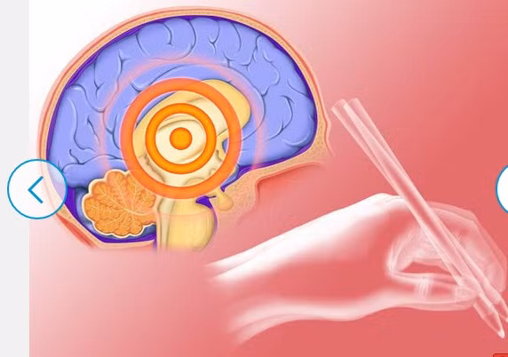 Bệnh Parkinson có biểu hiện là sự thay đổi của cơ thể và trí tuệ (di chuyển chậm chạp, yếu, mất trí nhớ, khó tập trung và gặp khó khăn trong điều hành các chi.