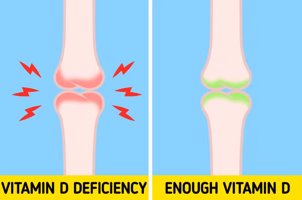 Đau nhức xương. Vitamin D đóng vai trò quan trọng trong việc hấp thụ canxi và chuyển hoá xương. Thiếu chất này làm tăng nguy cơ mắc các bệnh viêm khớp dạng thấp. Thực tế, hầu hết trường hợp đau cơ mãn tính và các vấn đề liên quan đến xương thường liên quan đến thiếu vitamin D.