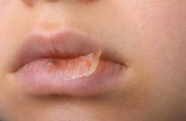 Khi thời tiết hanh khô, trẻ thường bị nẻ môi. Điều này bắt nguồn từ cấu tạo môi là những mô niêm mạc, lớp sừng rất mỏng. Mùa đông độ ẩm không khí thấp, môi dễ bị bong tróc do thiếu nước. (Ảnh minh họa)