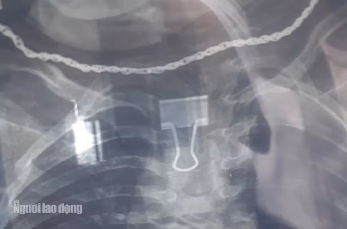 Tá hỏa phát hiện kẹp giấy mắc trong cổ bé 2 tuổi Ta hoa phat hien kep giay mac trong co be 2 tuoi