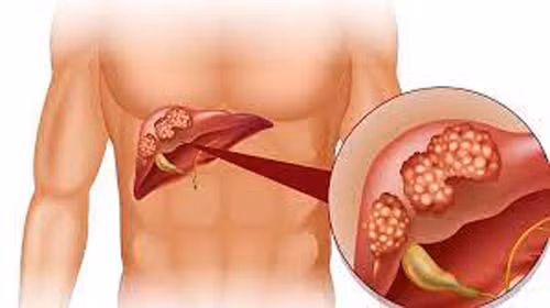 Mắc các bệnh về gan, tiểu đường cũng có thể khiến hơi thở bạn có mùi.