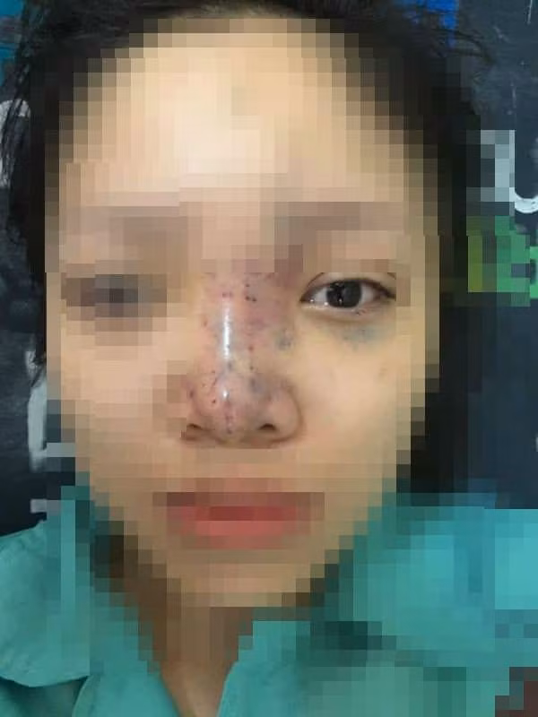Nữ sinh bị mù mắt khi tiêm filler: Dấu hiệu đáng ngờ bên trong spa - Hình 2 Nu sinh bi mu mat khi tiem filler: Dau hieu dang ngo ben trong spa-Hinh-2