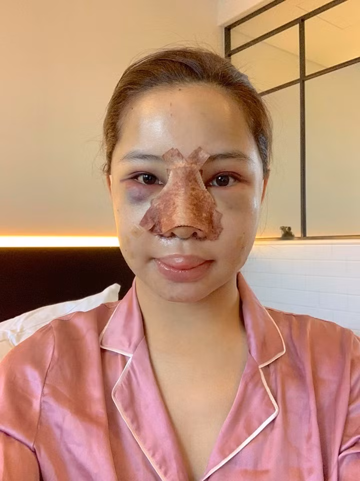 Nữ diễn viên chia sẻ hình ảnh gương mặt sưng nề sau khi ra viện.