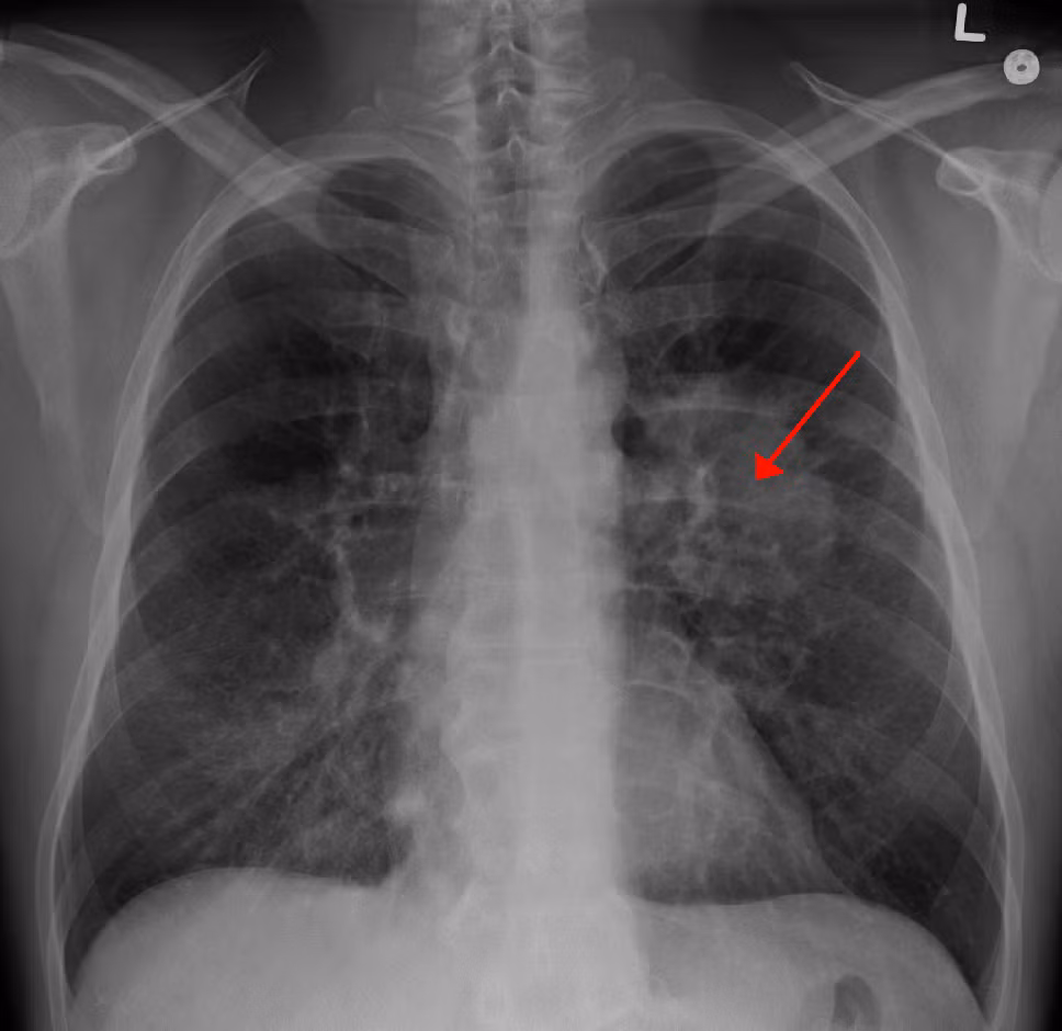 Theo đó, Dịch vụ Y tế Quốc gia Anh (NHS) kêu gọi những người có các triệu chứng như ho dai dẳng kéo dài hãy đi khám sớm, bởi theo các chuyên gia y tế, việc phát hiện bệnh sớm giúp ích cho quá trình điều trị bất cứ loại ung thư nào. Ảnh: Wikipedia.