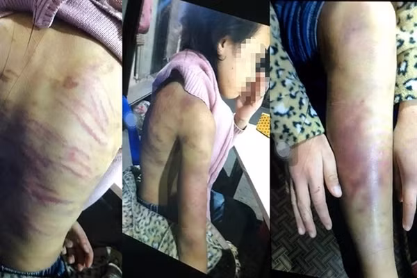 Những vụ bạo hành trẻ em rúng động dư luận - Hình 4 Nhung vu bao hanh tre em rung dong du luan-Hinh-4