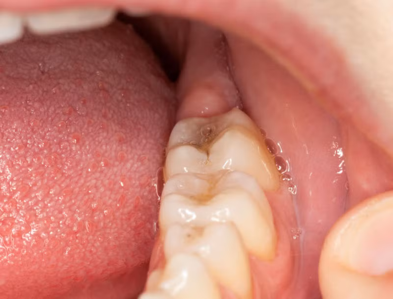 Người bị tiểu đường cũng có nguy cơ bị sâu răng và nhiễm trùng nướu cao hơn. Ảnh: dieutrirangsau.