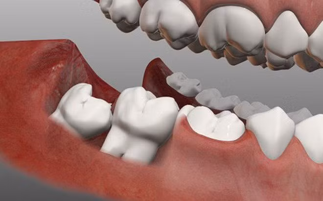 Trong suốt thời gian điều trị nhổ răng khôn, bạn tuyệt đối không được uống rượu. Ảnh: amazonaws.