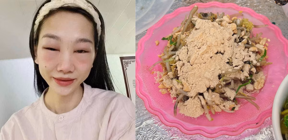 Nhận định về trường hợp dị ứng do ăn giá bể, các bác sĩ cho biết, thực khách có triệu chứng điển hình của phản vệ độ một hay phản ứng dị ứng nhẹ. Ảnh Internet