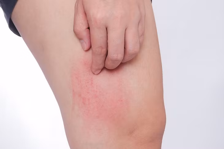 Nguyên nhân tình trạng bắt nguồn từ việc lượng đường trong máu tăng cao, lượng đường trong dịch mồ hôi tiết ra cũng tăng theo. Điều này tạo điều kiện cho vi khuẩn và nấm phát triển. Sức đề kháng của da lúc này cũng suy yếu, người bệnh dễ có cảm giác khó chịu, ngứa ngáy.