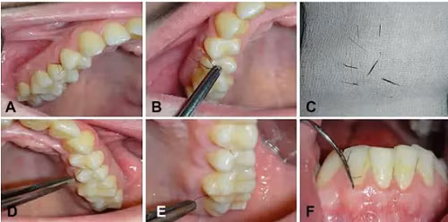Cô gái 25 tuổi mọc lông ở nướu răng, bác sĩ sửng sốt - Hình 2 Co gai 25 tuoi moc long o nuou rang, bac si sung sot-Hinh-2