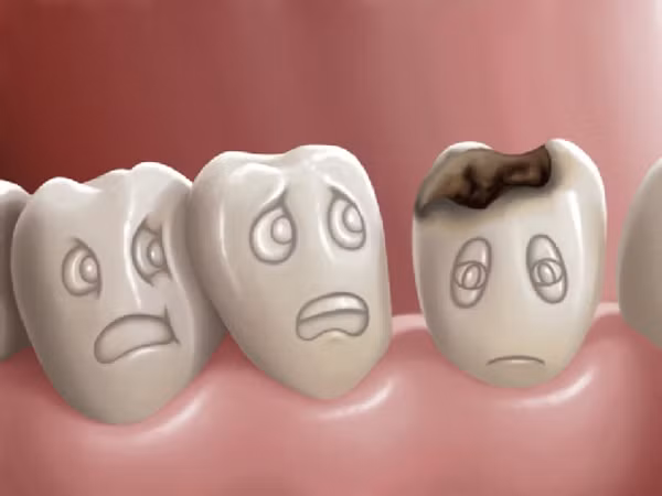 Không chỉ có tính ăn mòn, bác sĩ nha khoa cho biết hầu hết các loại đồ uống có ga đều chứa rất nhiều đường. Trong khi đó, đường là một trong những thứ có hại cho răng miệng bậc nhất.