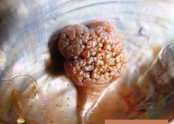 Ngọc trai hình súp lơ. Trước anh Bình thì anh Nguyễn Xuân Hùng cùng xóm cũng đã nhặt được ngọc quý. Đó là trong một lần mổ trai, anh đã phát hiện một viên ngọc màu hồng tía, hơi nhạt. Song thời đó, chuyện này không mấy xôn xao bởi viên ngọc chỉ có hình như một cây súp lơ. Anh cho biết đã từng có người trả giá viên ngọc này 10 triệu đồng. Nhưng vì muốn giữ làm kỷ niệm, anh đã từ chối.