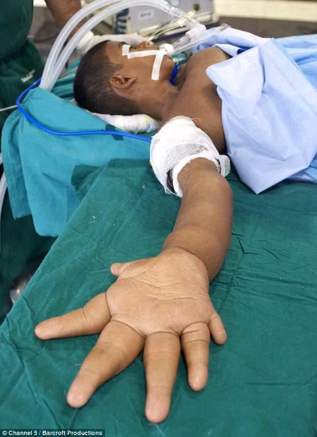 Trong ca phẫu thuật đầu tiên kéo dài 8 giờ này, các bác sĩ chỉ mới thực hiện thủ thuật để tay cậu bé không thể tăng trưởng thêm nữa.