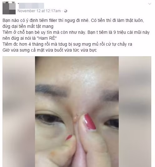Nhận trái đắng từ trào lưu nâng mũi bằng tiêm filler - Hình 2 Nhan trai dang tu trao luu nang mui bang tiem filler-Hinh-2