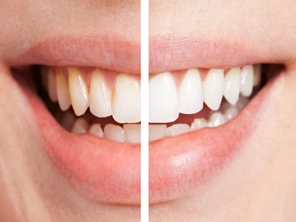 Mảng bám răng nhiều. Xuất hiện nhiều mảng bám răng cũng có thể là một trong những dấu hiệu sớm của bệnh tim ở độ tuổi 30. Những mảng bám răng này có thể gây viêm lợi, từ đó làm cho cơ chế miễn dịch của có thể phản ứng, biểu hiện là tế bào bạch cầu tăng nhiều. Một trong những nguyên nhân chủ yếu của bệnh tim chính là tế bào bạch cầu tăng nhiều. Vì vậy, đối với người có tình trạng tim không tốt, nên hình thành thói quen súc miệng sau bữa ăn.