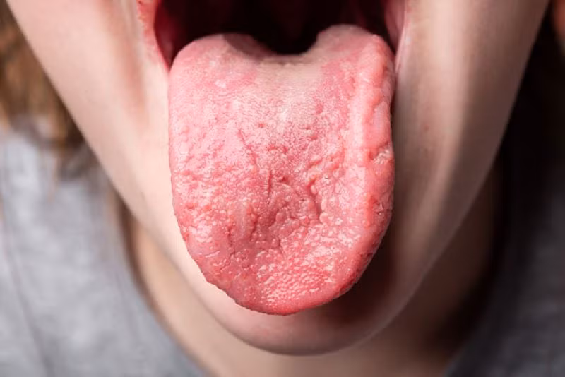  Lưỡi sưng, đỏ và có vết nứt: Gan khỏe mạnh giúp duy trì dòng chảy của máu và năng lượng trong cơ thể. Khi gan bị suy yếu, dòng chảy này bị gián đoạn, có thể gây ra tình trạng sưng lưỡi. Ngoài ra, lưỡi đỏ, có vết nứt và màu vàng ở giữa cũng có thể là dấu hiệu của gan nhiễm mỡ, viêm gan hoặc xơ gan. Ảnh minh họa 