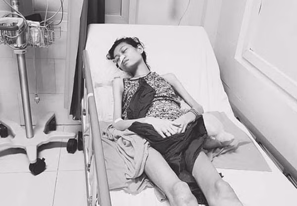 Xot xa hinh anh da boc xuong cua nguoi mau 9X mac benh hiem ngheo-Hinh-5